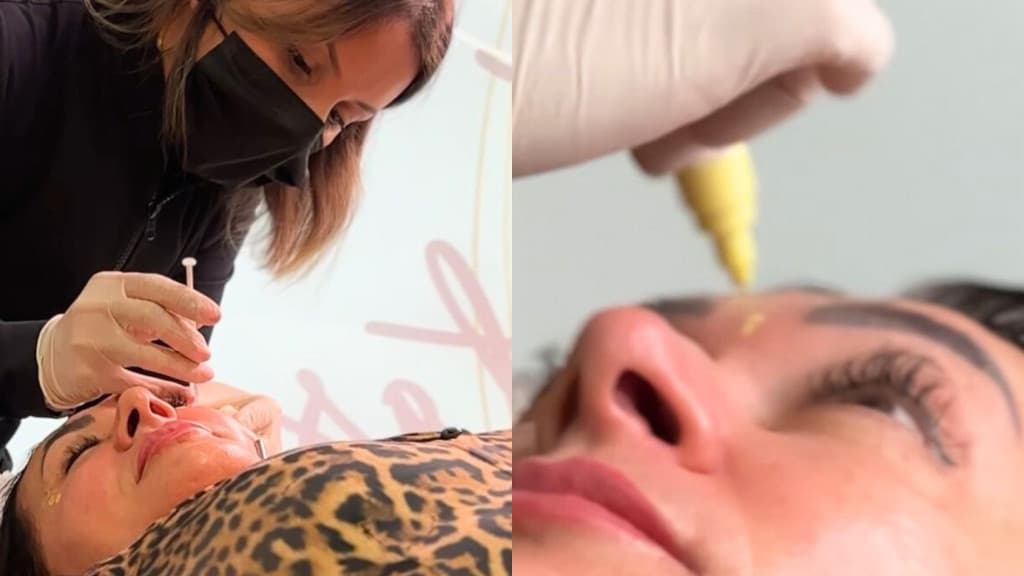 Descobrindo os benefícios do poderoso “Botox”