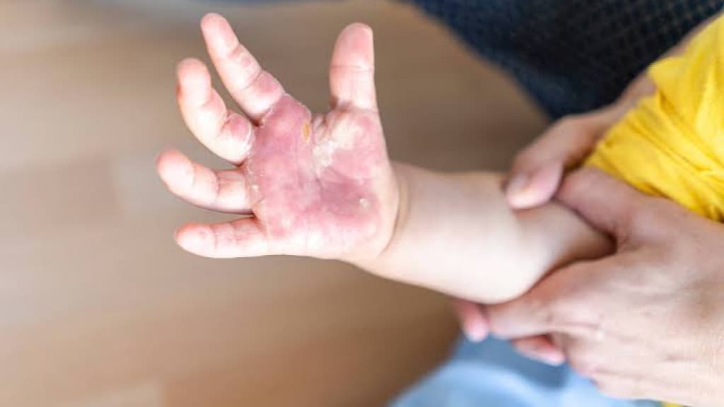 Bebê de um ano tem queimaduras de 2º grau pelo corpo em Capinzal