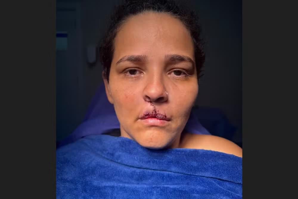 Mulher tem lábio arrancado por cachorro e passa por cirurgia gratuita em SC