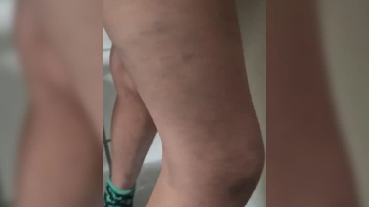 Pais adotivos são indiciados por tortura contra 3 filhos em SC: “espeto de churrasco e pedaço de pau”