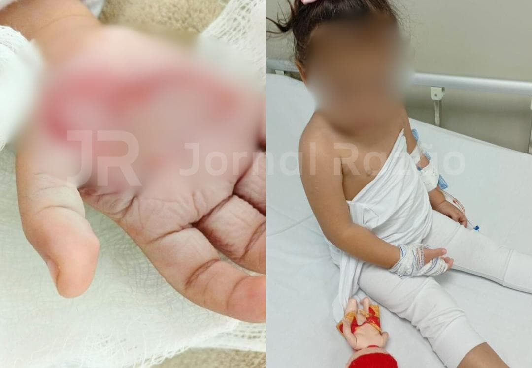 Madrasta esquenta colher e “derrete” mão de menina de 2 anos em Itajaí para se vingar