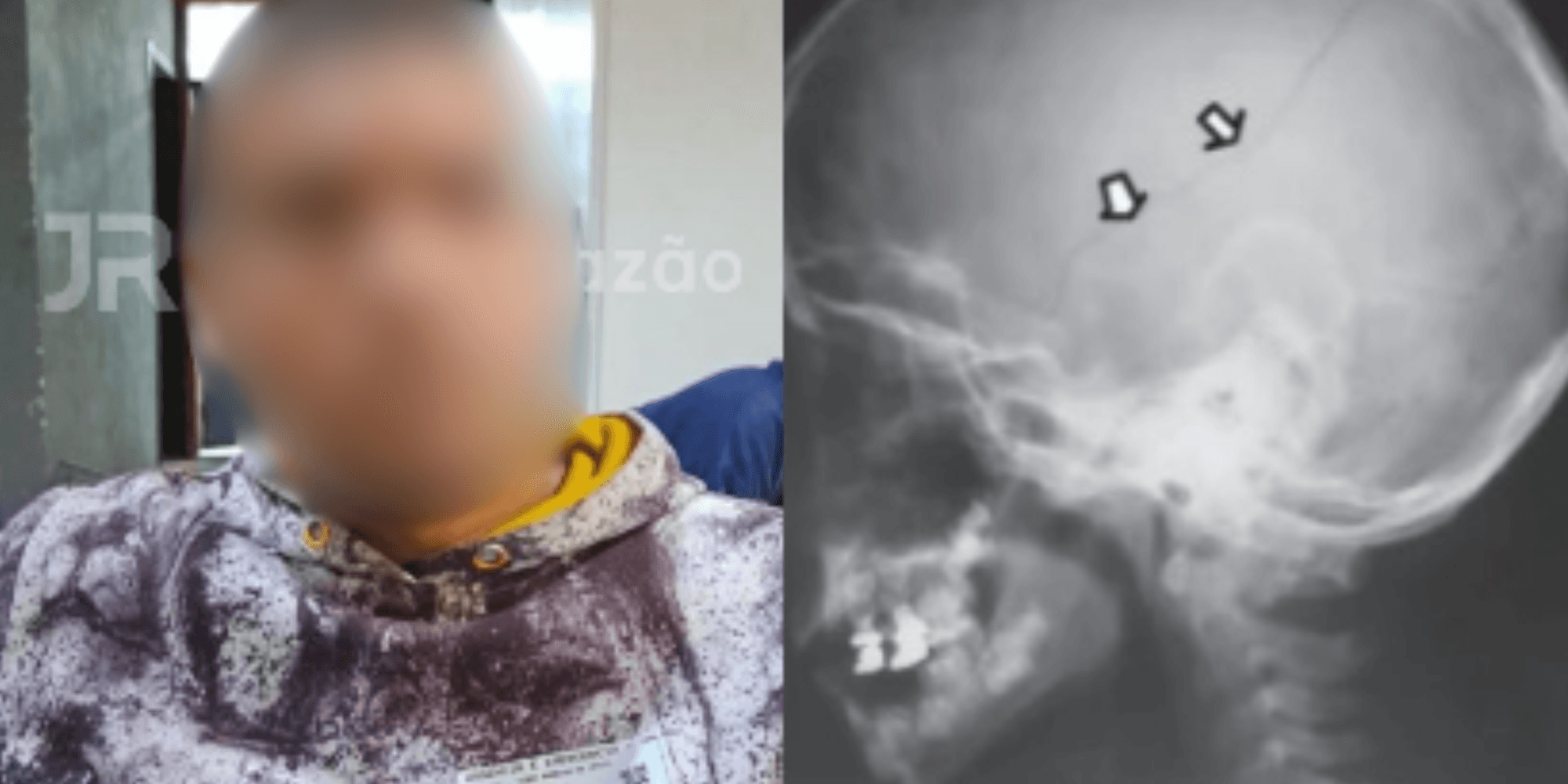 “Trauma cerebral”: padrasto é preso após menina de 4 anos ser internada na UTI em Blumenau