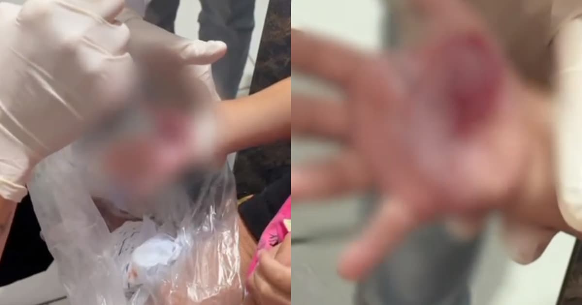 “Derreteu a mão”: revelado o motivo do castigo chocante de madrasta contra criança em Itajaí