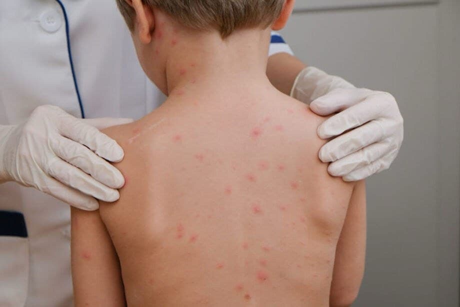 Cidade catarinense confirma caso de meningite bacteriana em criança