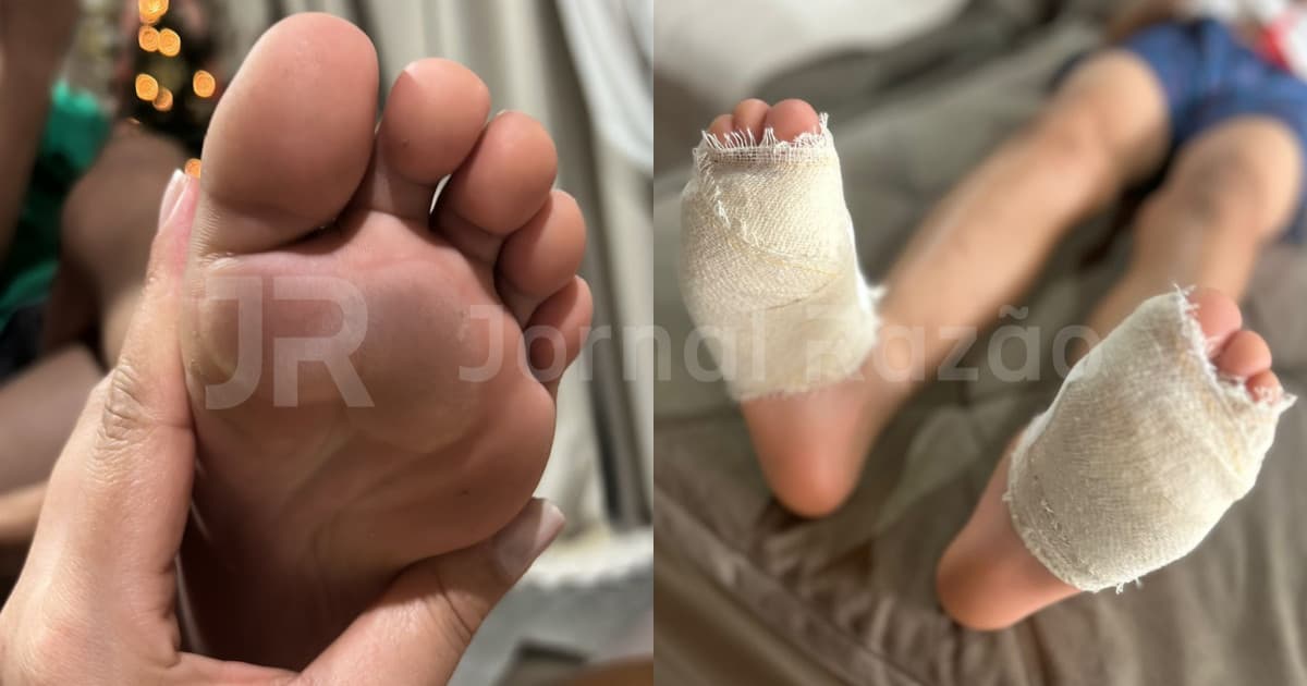 Criança volta com os pés queimados da escola em Canelinha e desabafa: “eu pedi para parar”