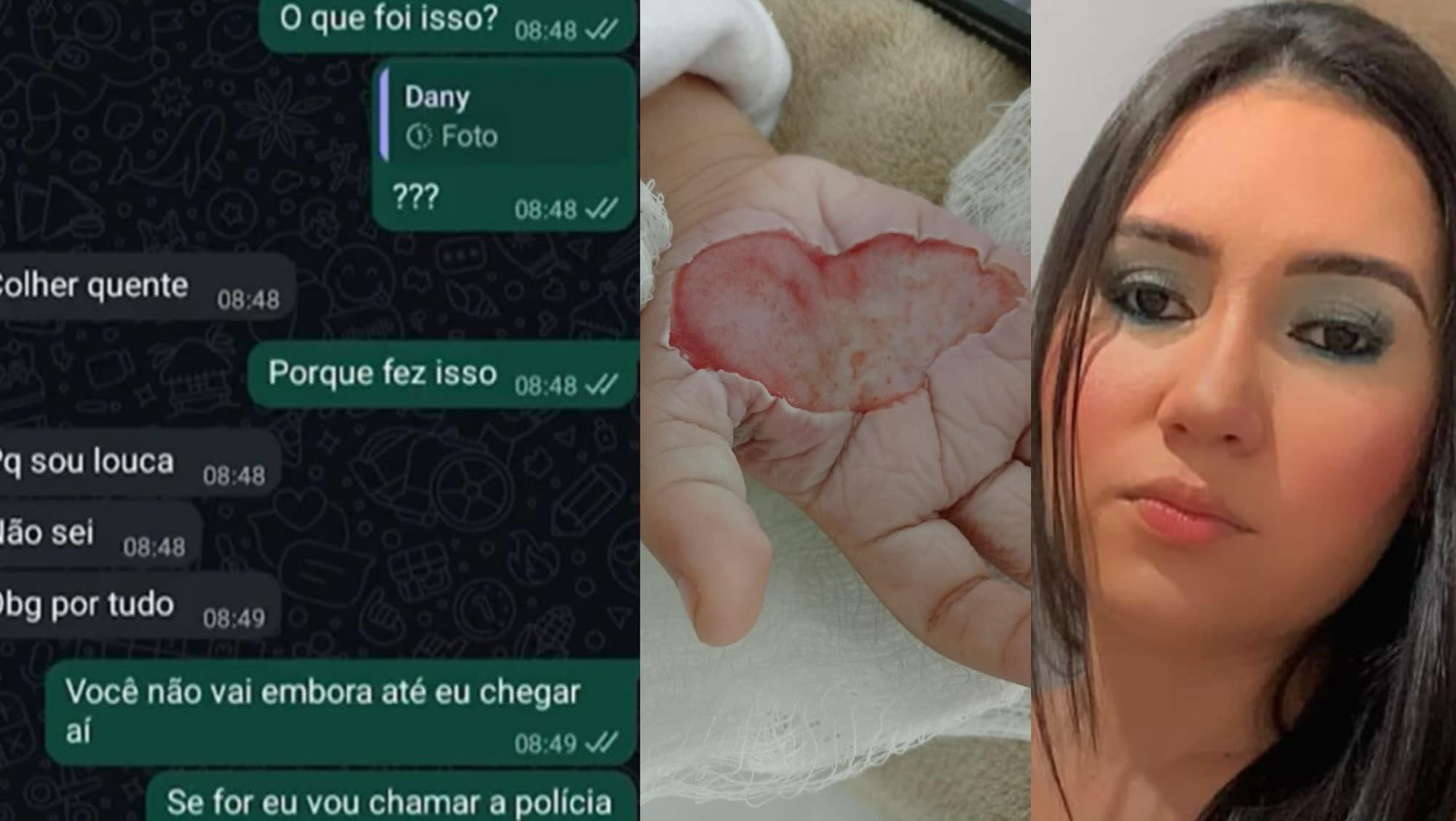 Madrasta que derreteu a mão de criança com colher quente é presa em Itapema: “pq sou louca”