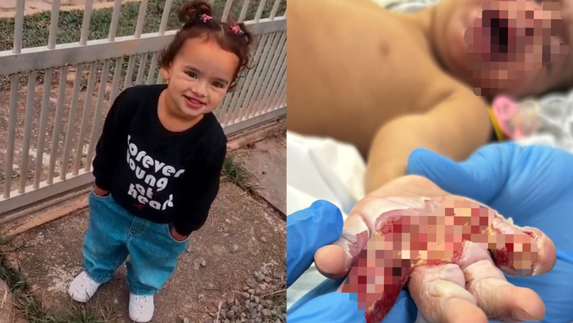 Menina de 2 anos sofre choque elétrico e perde movimentos da mão