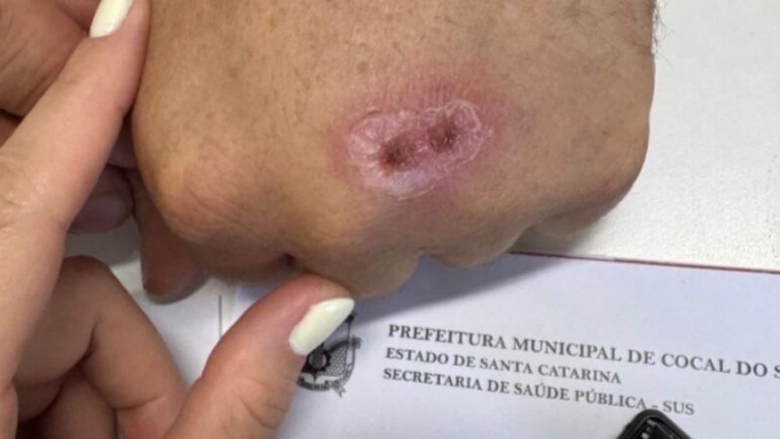 Cidade de Santa Catarina confirma caso de doença transmitida por gatos