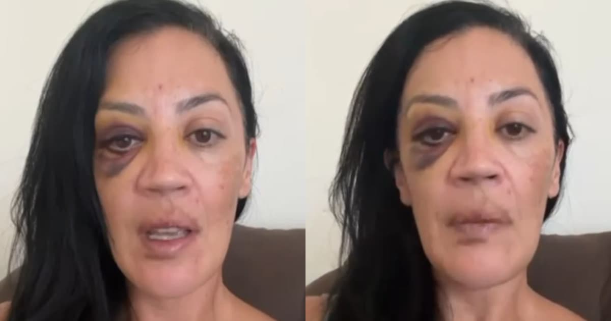 Com o rosto ferido, mulher denuncia agressões do companheiro em SC: “não é maquiagem”