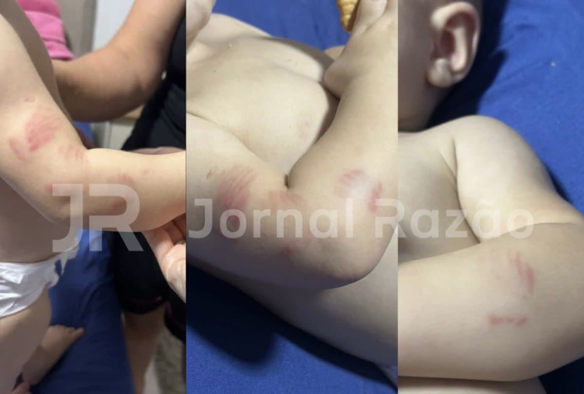 Bebê de 10 meses volta da creche com mordidas e hematomas pelo corpo em SC