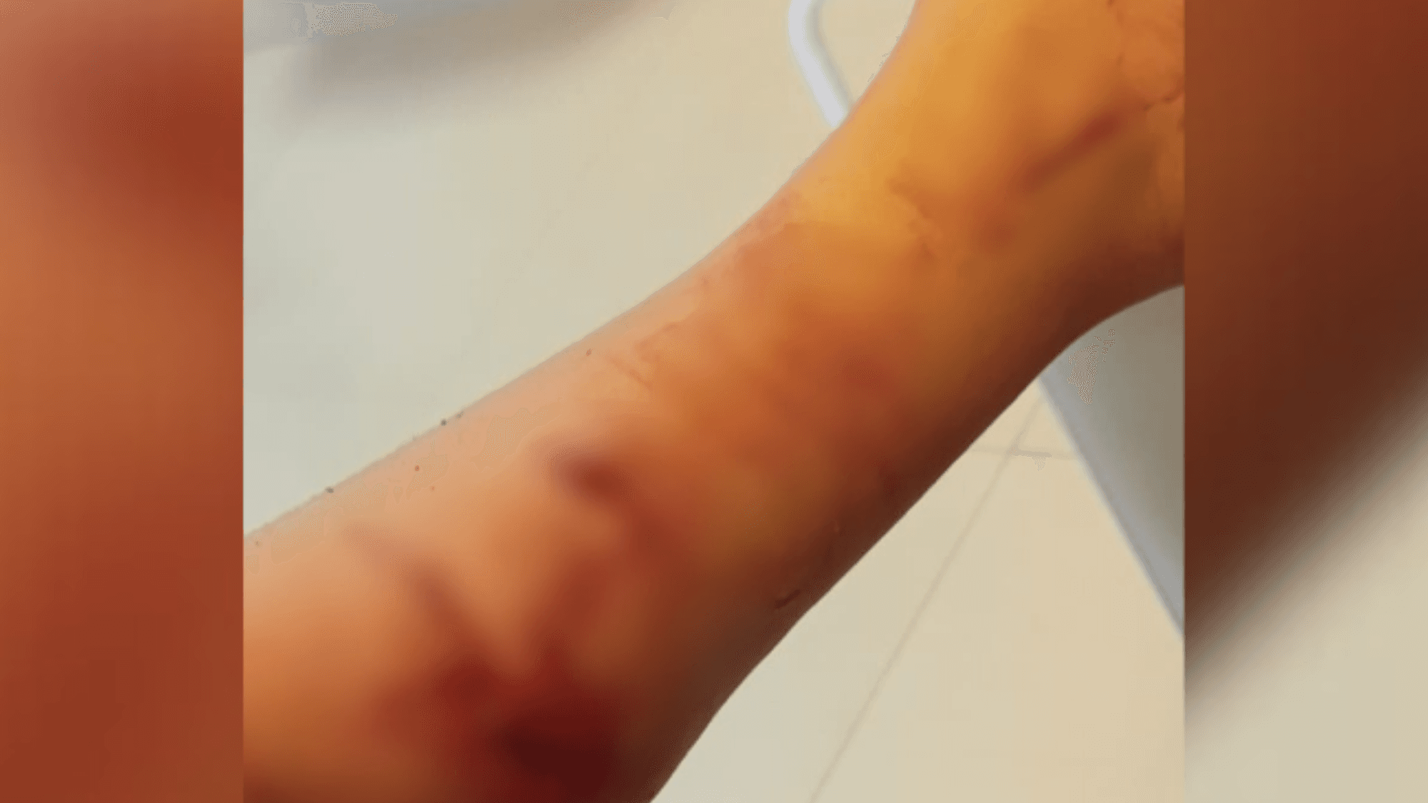 Criança de 3 anos é atacada por cachorro a caminho da creche em SC