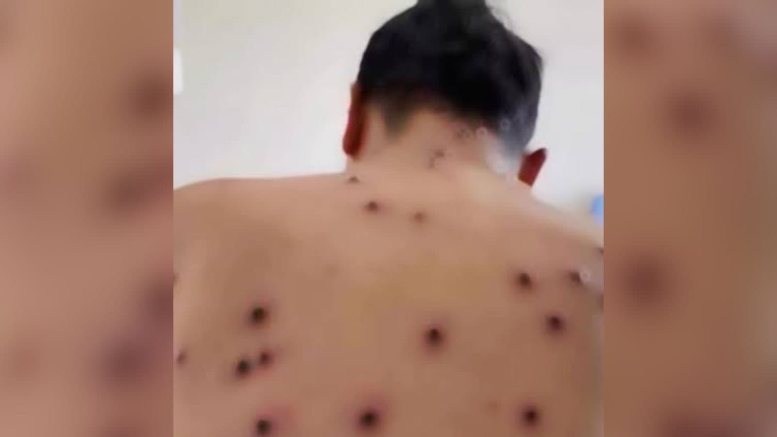 Técnico de enfermagem é internado com suspeita de mpox em hospital de Itajaí
