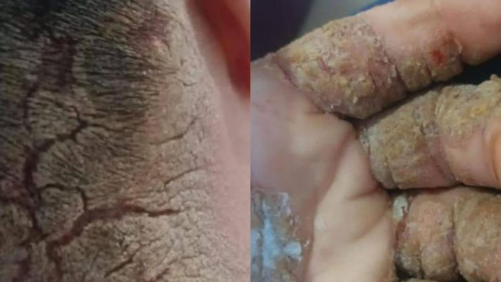 Família pede ajuda para tratar doença de pele rara em adolescente com síndrome de Down em SC
