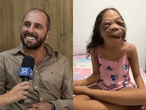 “Agora ela consegue enxergar”: cirurgião de SC transforma vidas com cirurgias de face gratuitas