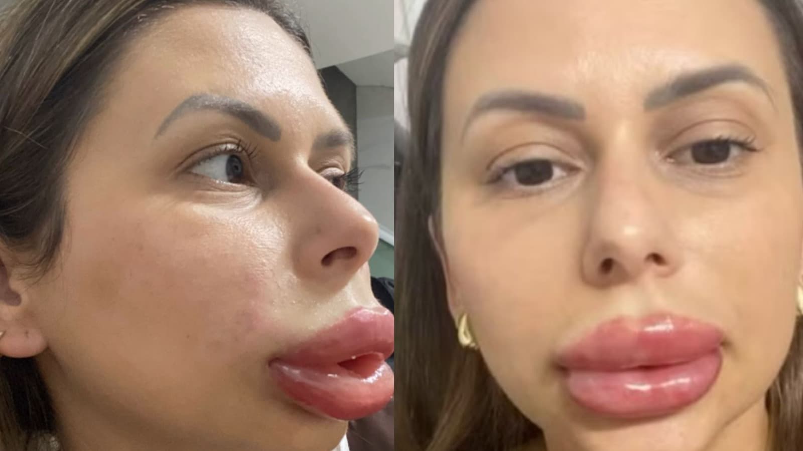 “Ficaram meses rindo”: preenchimento labial escondido vira piada de família em Florianópolis; VÍDEO