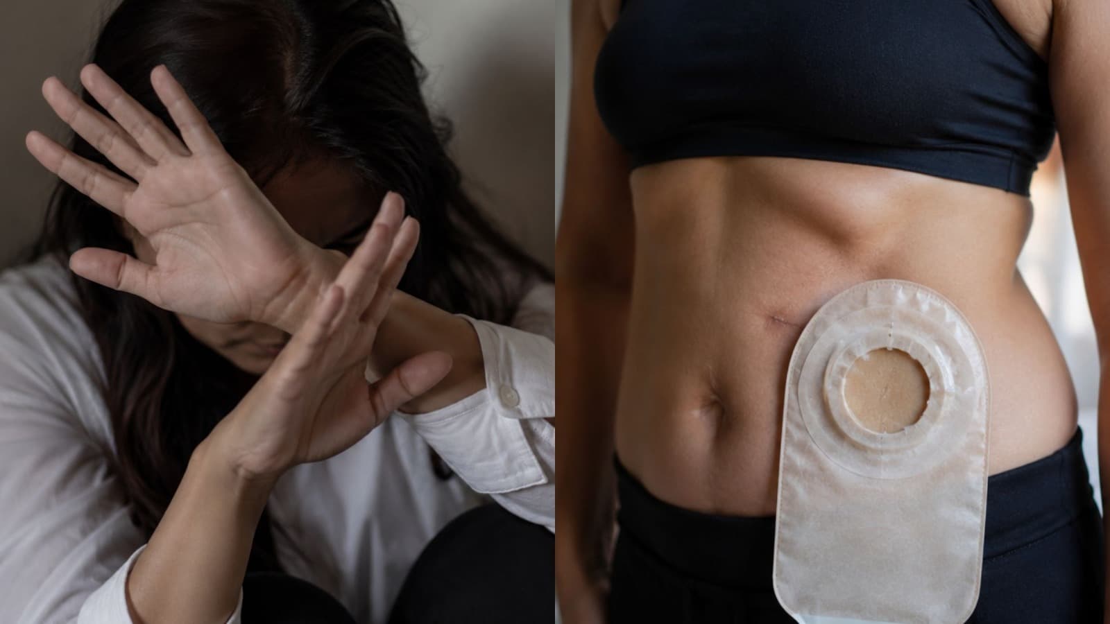 Mulher perde o útero e passa a usar bolsa de colostomia após ser dopada e estuprada pelo companheiro em SC