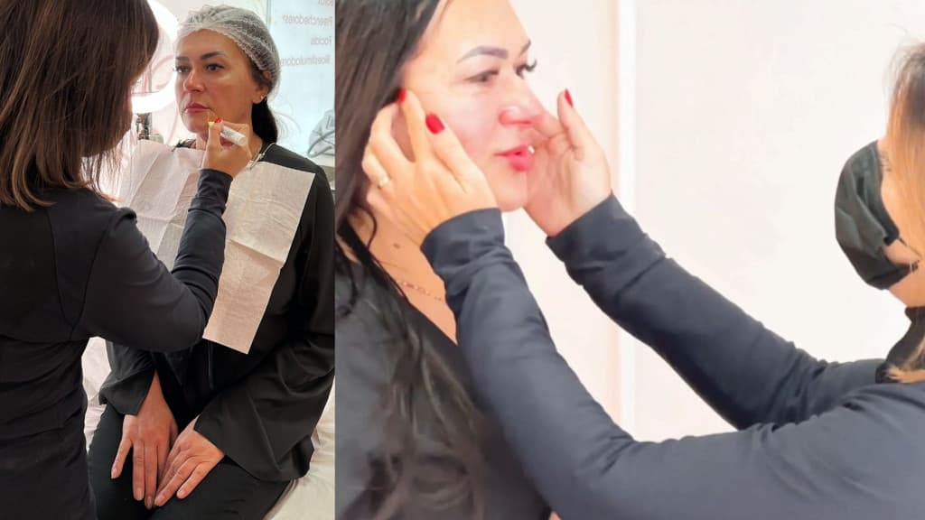 O fim do “Bigode Chinês”? Entenda as novas técnicas de preenchimento facial!