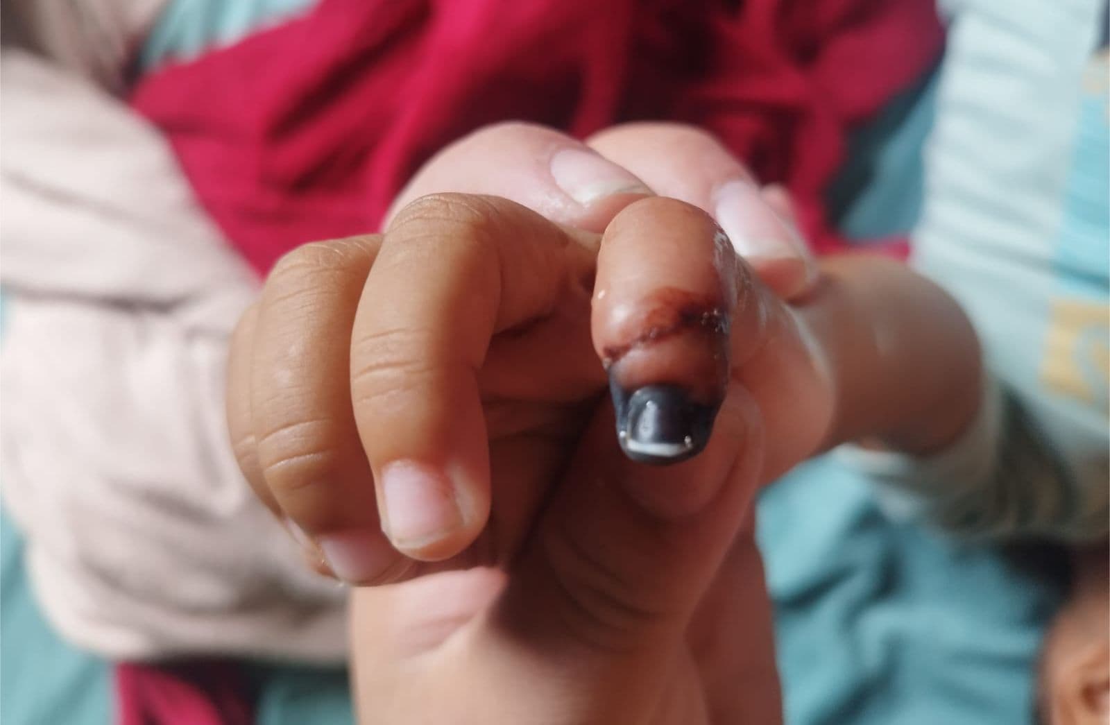 “Nem olharam pra ele!”: criança de 2 anos perde parte do dedo após atendimento desastroso em hospital