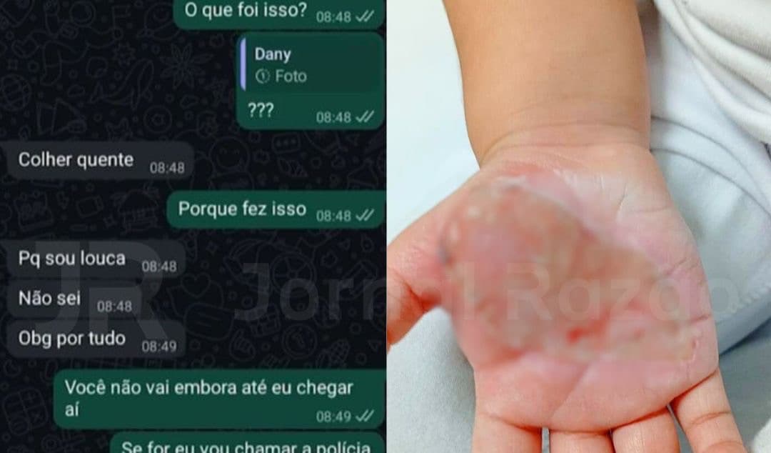 “Fiz pq sou louca”: madrasta solta após queimar mão de menina de 2 anos em SC admite crime
