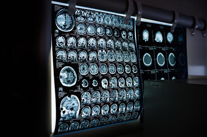 Trataram de sinusite o que era hematoma no cérebro: paciente que fez nove cirurgias será indenizado em SC