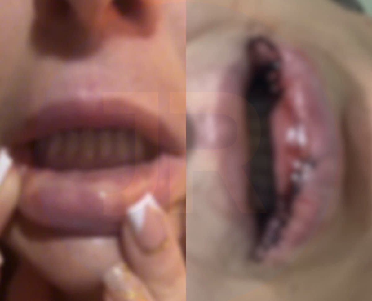 “Se recusou a dizer o que aplicou”: seis mulheres denunciam clínica de estética em SC após ficarem com os lábios deformados