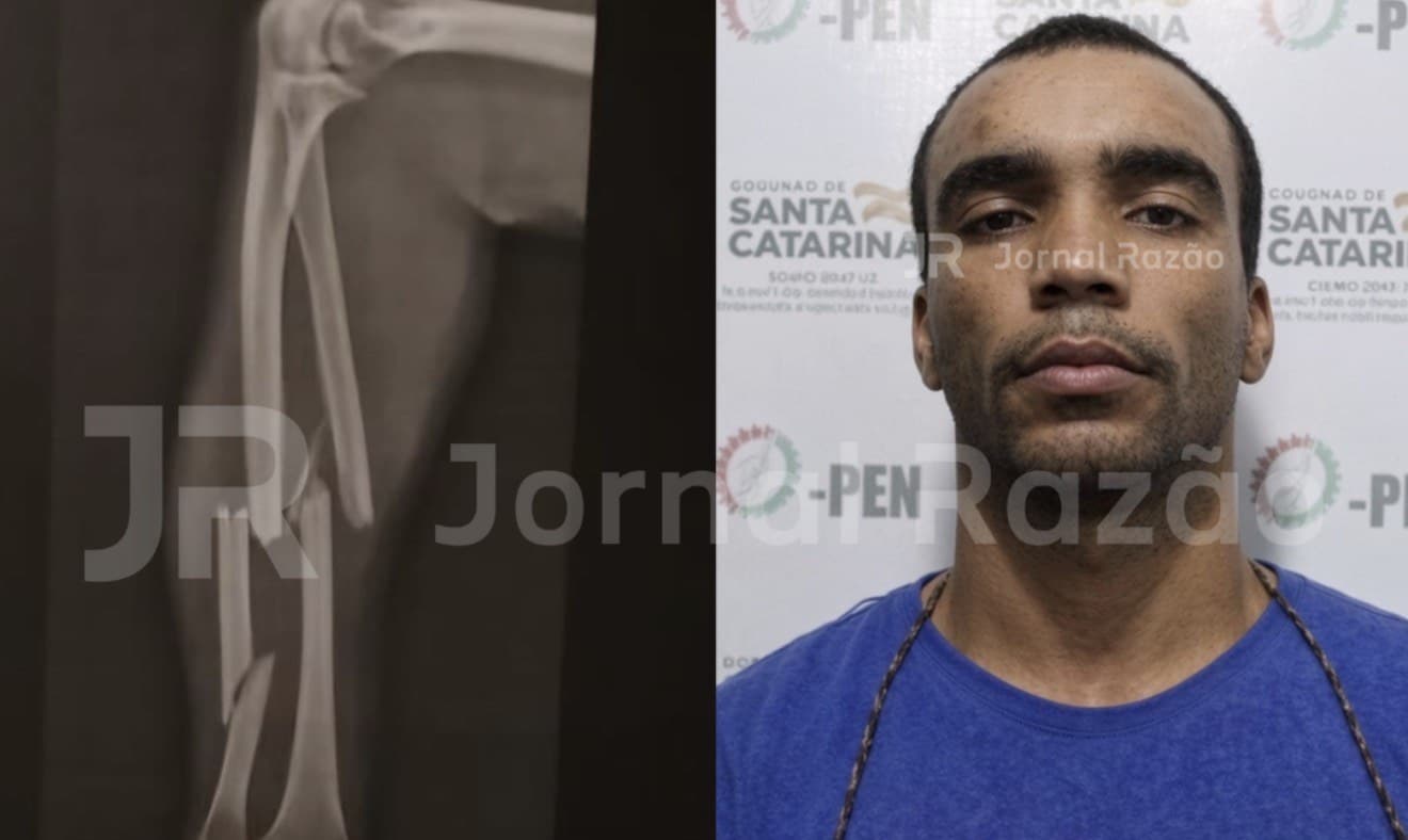 Montagem com radiografia do braco fraturado da vitima e foto do homem preso por tentativa de feminicidio em Tijucas